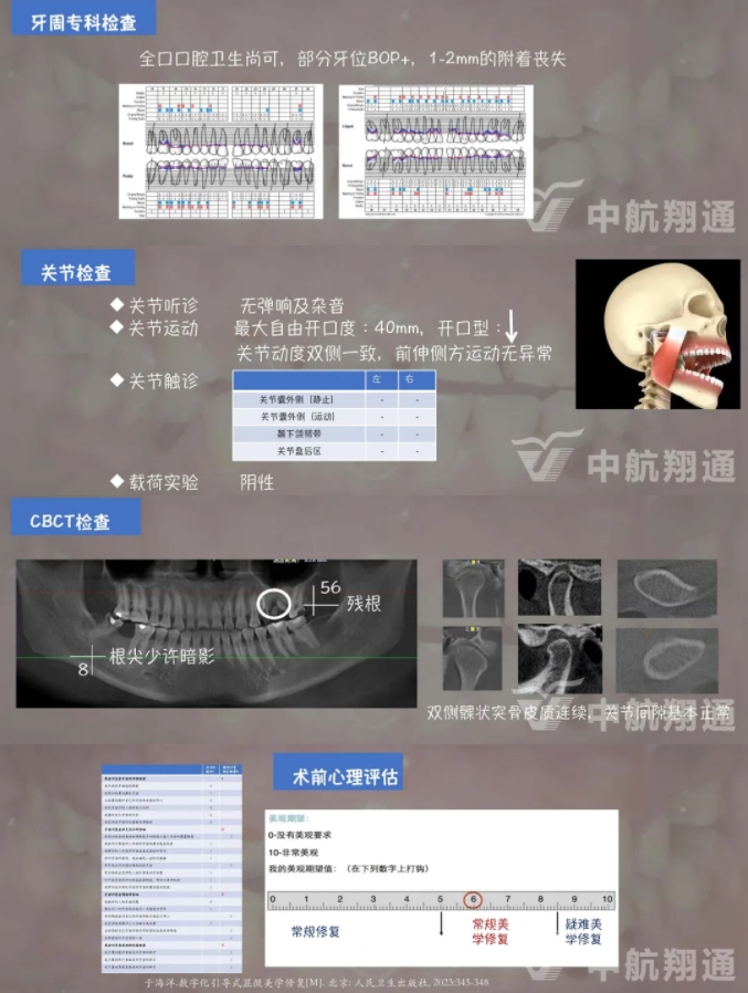 2024華人美學(xué)臨床病例大賽獲獎病例|數(shù)字化輔助牙列重度磨耗的美學(xué)和功能重建一例