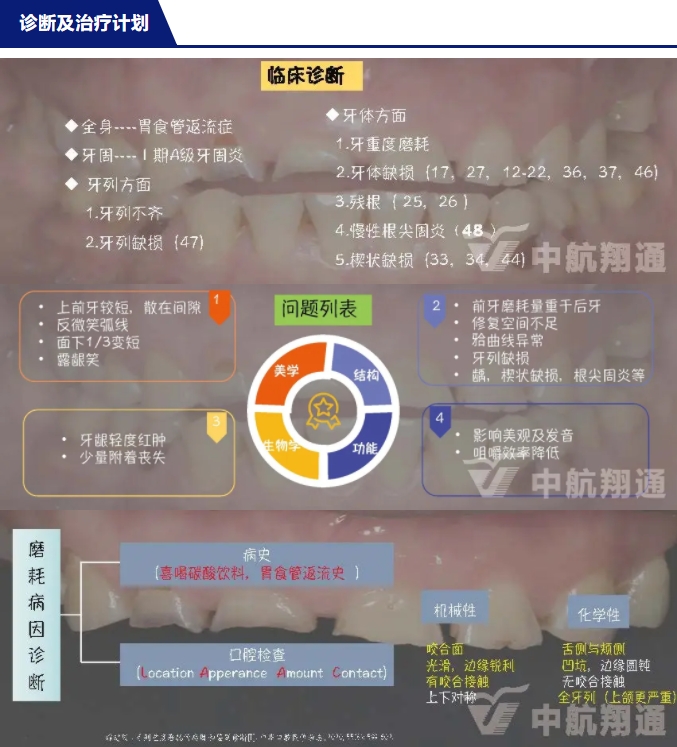 2024華人美學(xué)臨床病例大賽獲獎病例|數(shù)字化輔助牙列重度磨耗的美學(xué)和功能重建一例