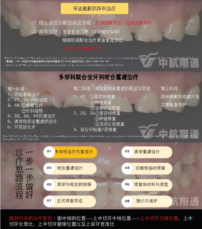 2024華人美學(xué)臨床病例大賽獲獎病例|數(shù)字化輔助牙列重度磨耗的美學(xué)和功能重建一例