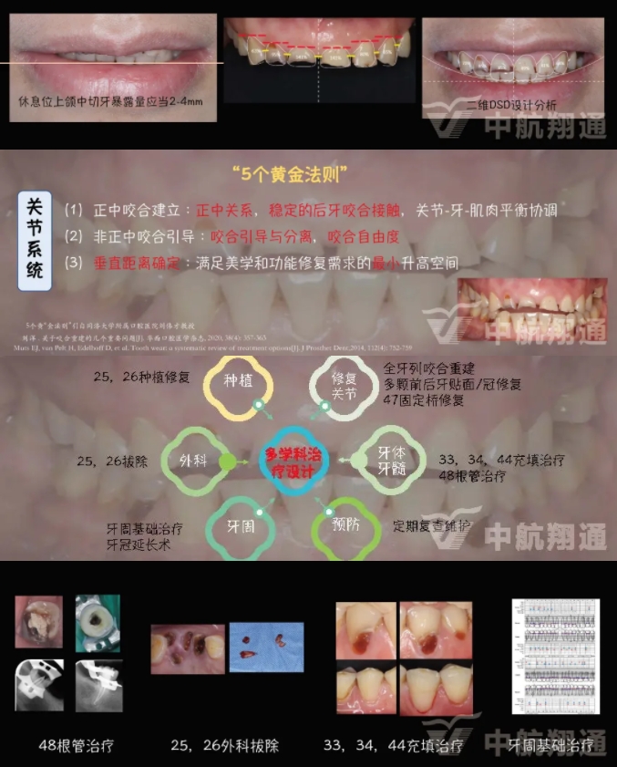 2024華人美學(xué)臨床病例大賽獲獎病例|數(shù)字化輔助牙列重度磨耗的美學(xué)和功能重建一例