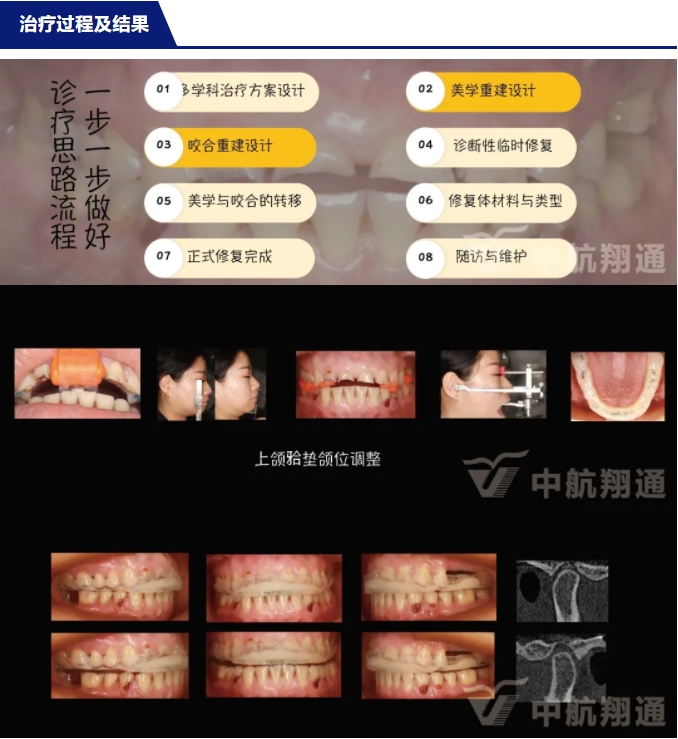 2024華人美學(xué)臨床病例大賽獲獎病例|數(shù)字化輔助牙列重度磨耗的美學(xué)和功能重建一例