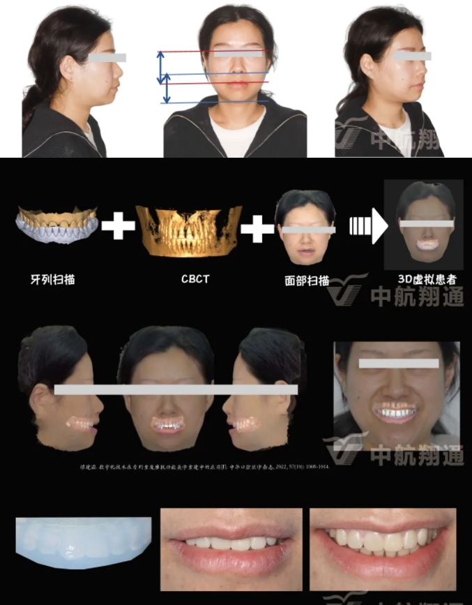 2024華人美學(xué)臨床病例大賽獲獎病例|數(shù)字化輔助牙列重度磨耗的美學(xué)和功能重建一例