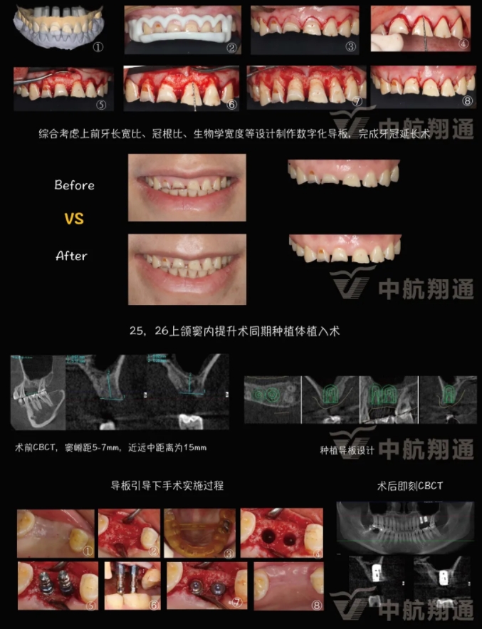 2024華人美學(xué)臨床病例大賽獲獎病例|數(shù)字化輔助牙列重度磨耗的美學(xué)和功能重建一例