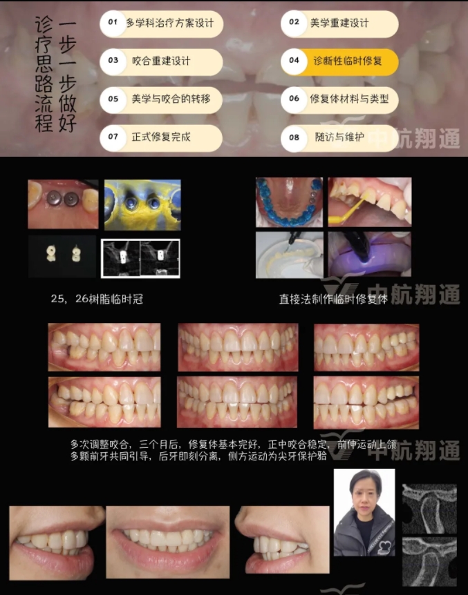 2024華人美學(xué)臨床病例大賽獲獎病例|數(shù)字化輔助牙列重度磨耗的美學(xué)和功能重建一例