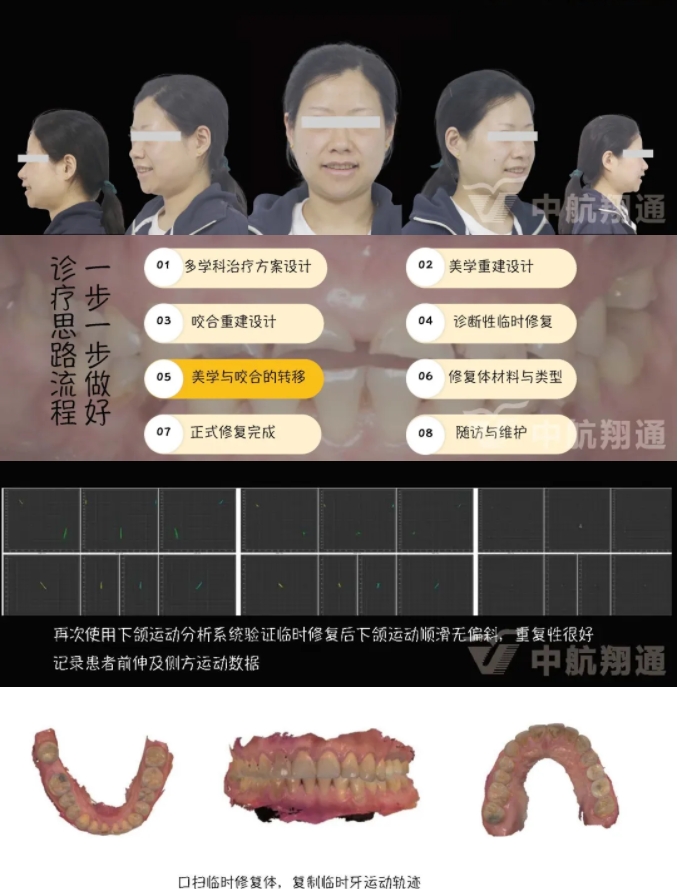 2024華人美學(xué)臨床病例大賽獲獎病例|數(shù)字化輔助牙列重度磨耗的美學(xué)和功能重建一例