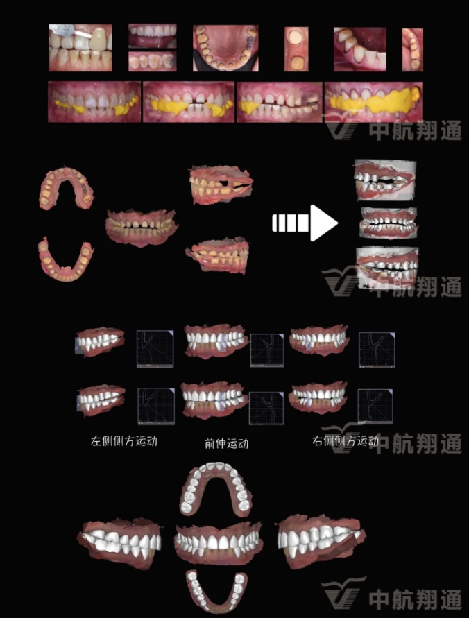2024華人美學(xué)臨床病例大賽獲獎病例|數(shù)字化輔助牙列重度磨耗的美學(xué)和功能重建一例