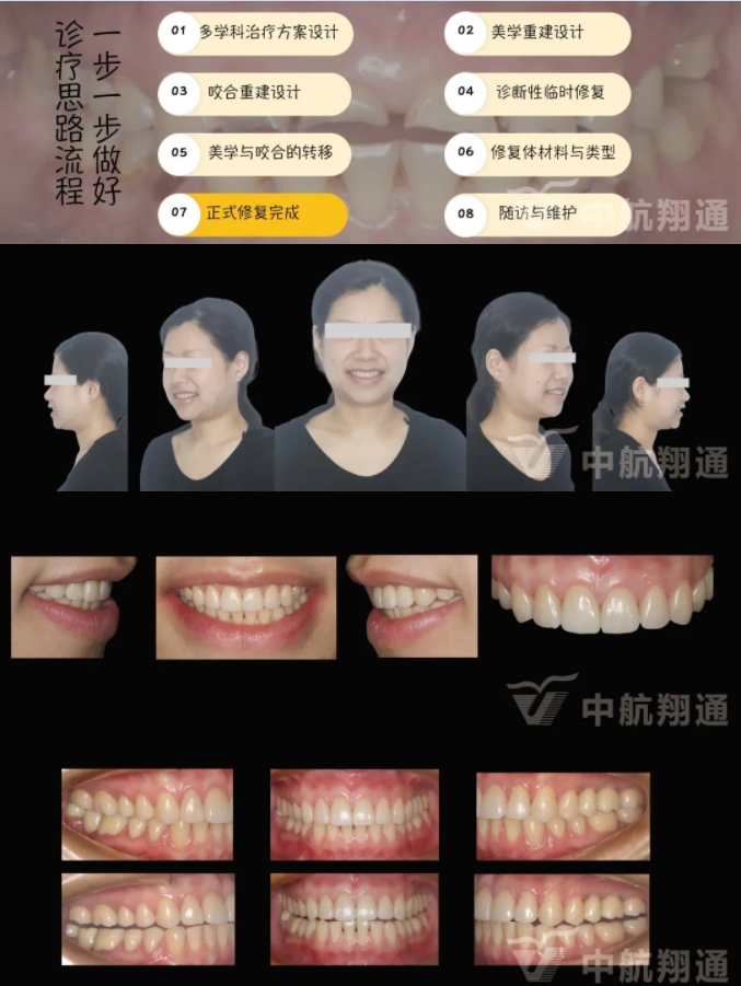 2024華人美學(xué)臨床病例大賽獲獎病例|數(shù)字化輔助牙列重度磨耗的美學(xué)和功能重建一例