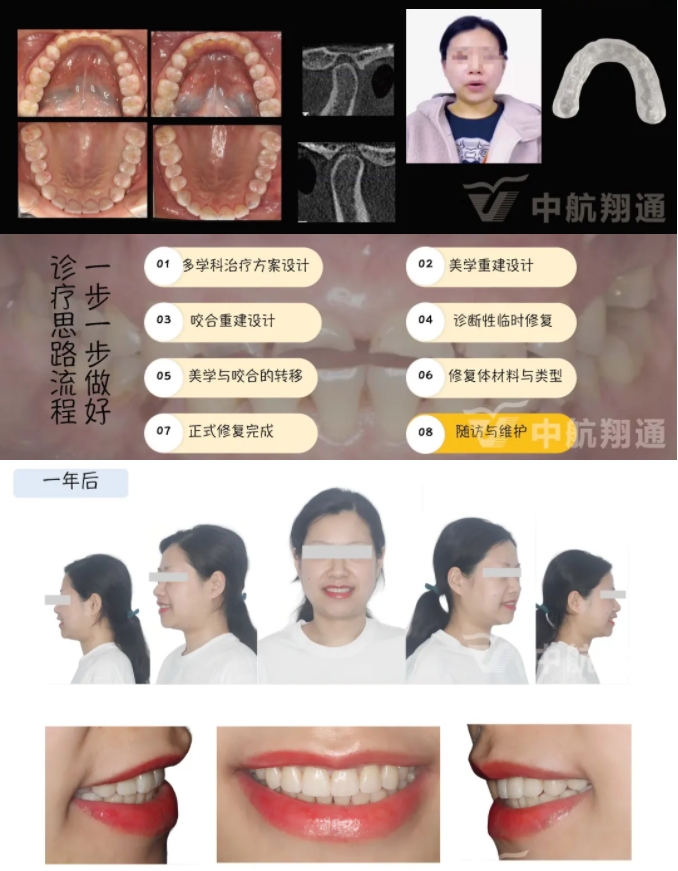 2024華人美學(xué)臨床病例大賽獲獎病例|數(shù)字化輔助牙列重度磨耗的美學(xué)和功能重建一例