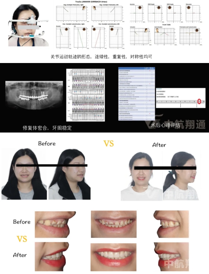 2024華人美學(xué)臨床病例大賽獲獎病例|數(shù)字化輔助牙列重度磨耗的美學(xué)和功能重建一例