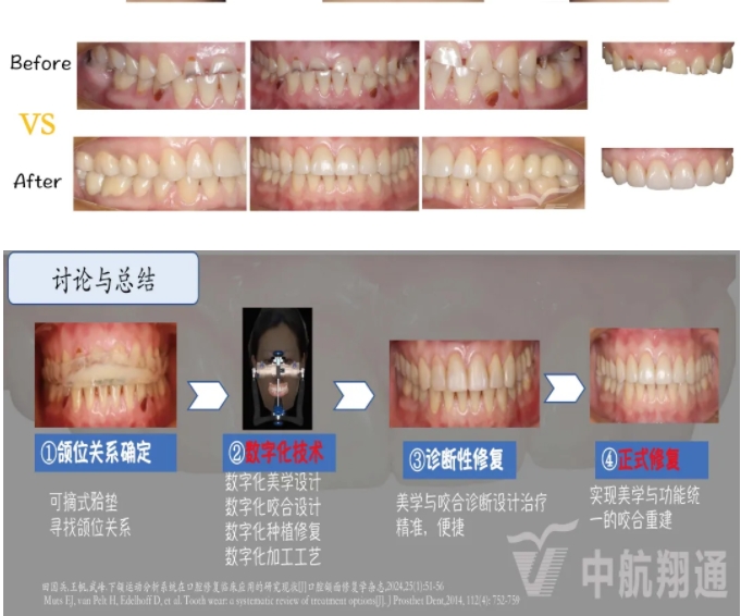2024華人美學(xué)臨床病例大賽獲獎病例|數(shù)字化輔助牙列重度磨耗的美學(xué)和功能重建一例