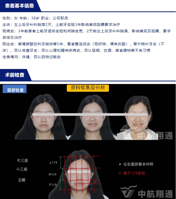 2024華人美學(xué)臨床病例大賽獲獎病例|數(shù)字化輔助牙列重度磨耗的美學(xué)和功能重建一例
