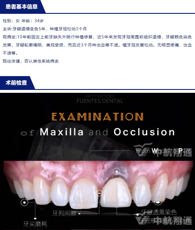 PSTD軟組織增量之后的美學(xué)修復(fù)
