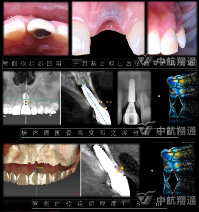 PSTD軟組織增量之后的美學(xué)修復(fù)