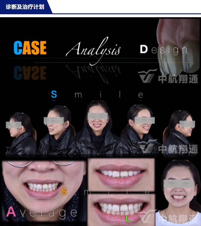 PSTD軟組織增量之后的美學(xué)修復(fù)