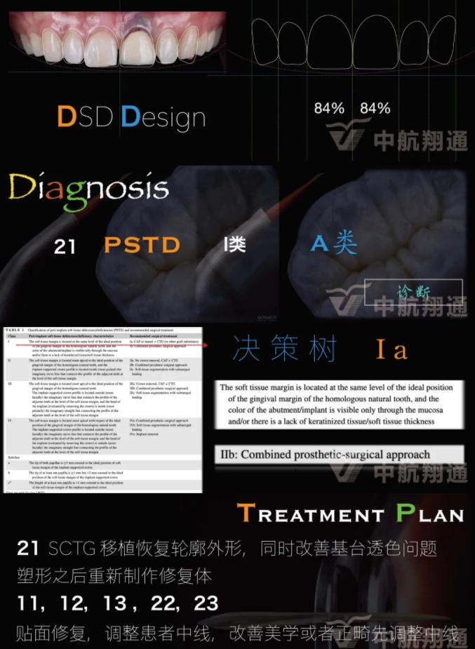 PSTD軟組織增量之后的美學(xué)修復(fù)