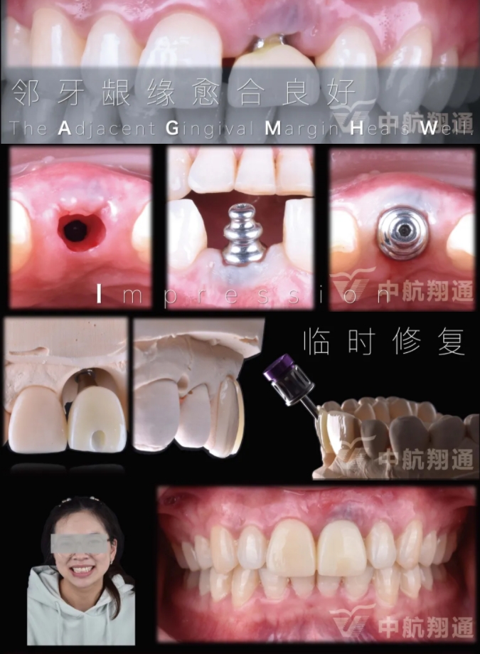 PSTD軟組織增量之后的美學(xué)修復(fù)