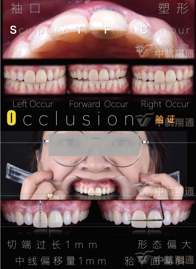 PSTD軟組織增量之后的美學(xué)修復(fù)