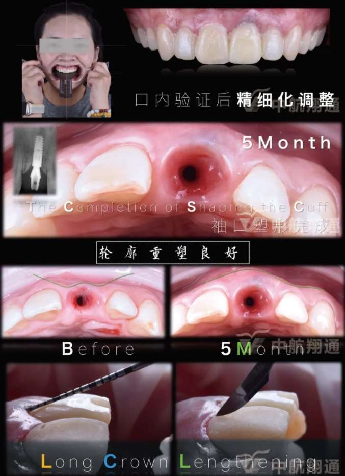PSTD軟組織增量之后的美學(xué)修復(fù)