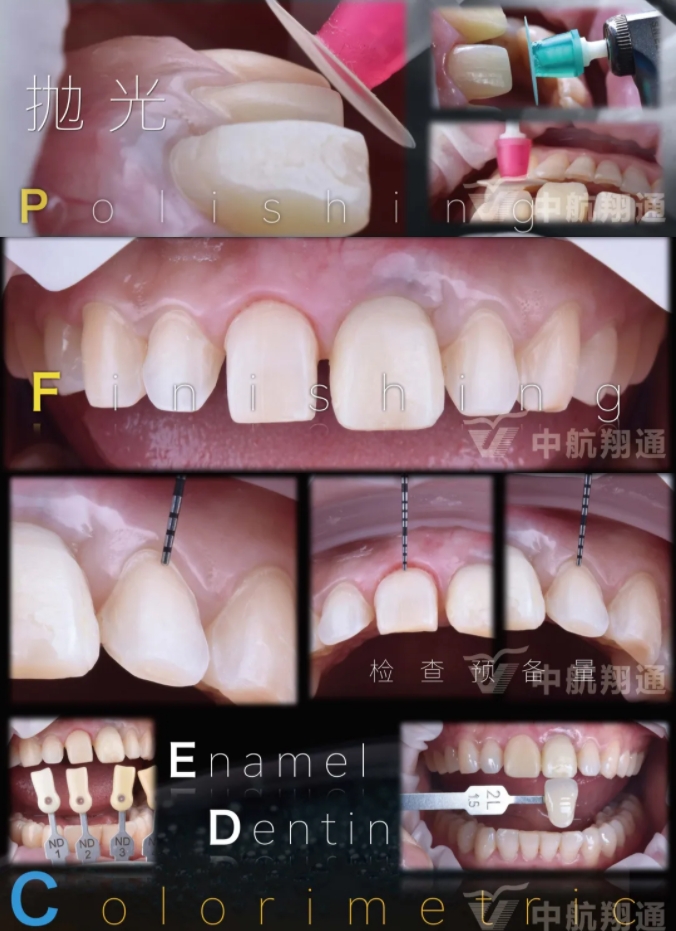 PSTD軟組織增量之后的美學(xué)修復(fù)