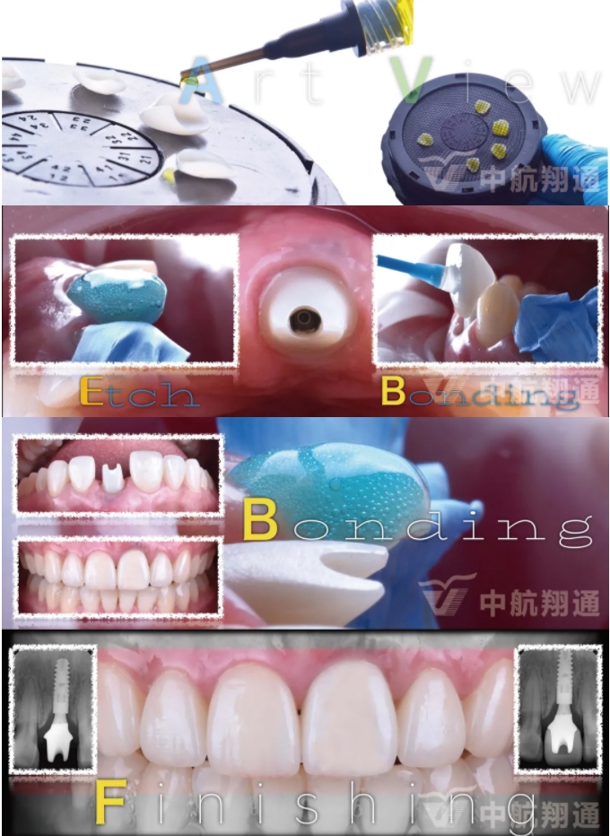 PSTD軟組織增量之后的美學(xué)修復(fù)