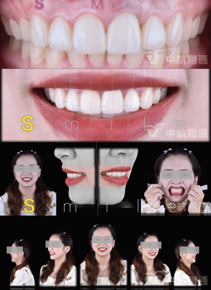 PSTD軟組織增量之后的美學(xué)修復(fù)