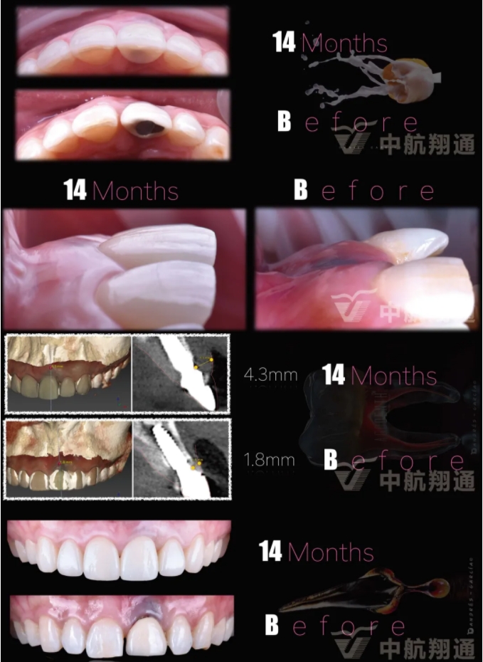 PSTD軟組織增量之后的美學(xué)修復(fù)