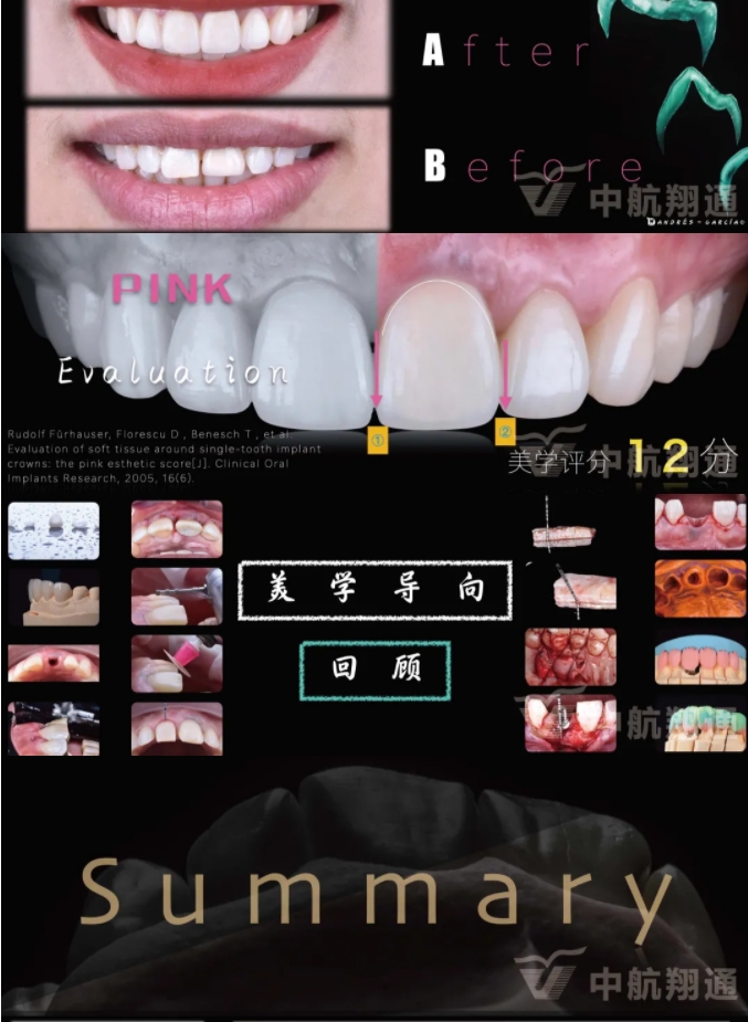 PSTD軟組織增量之后的美學(xué)修復(fù)