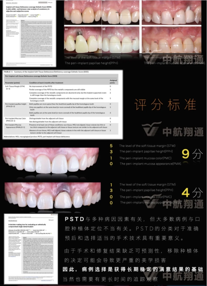 PSTD軟組織增量之后的美學(xué)修復(fù)