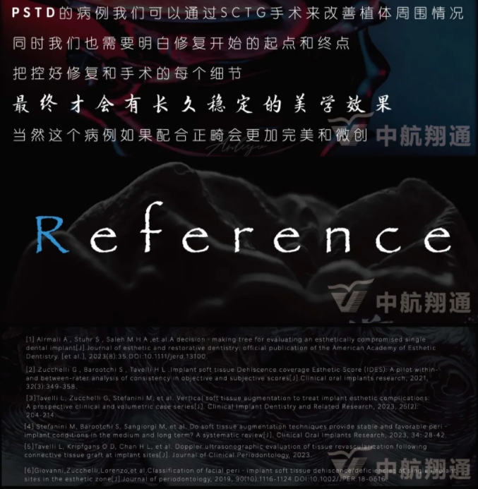 PSTD軟組織增量之后的美學(xué)修復(fù)