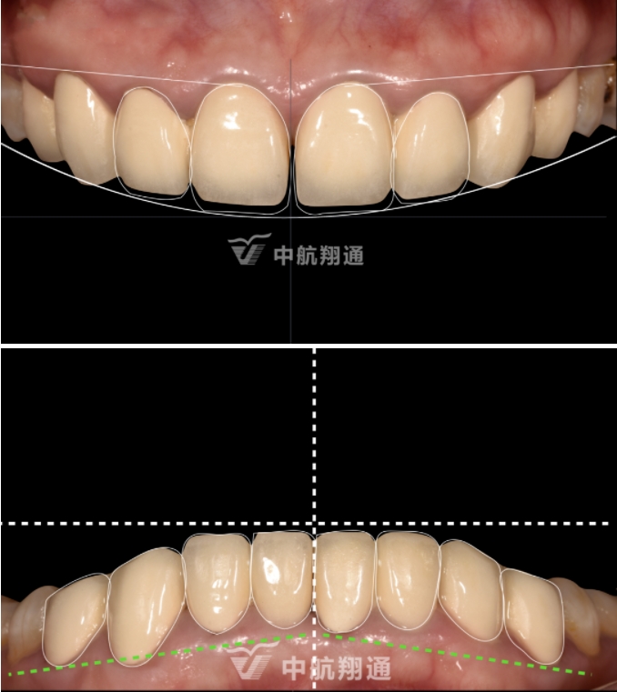 前牙全瓷美學(xué)修復(fù)臨床病例分享