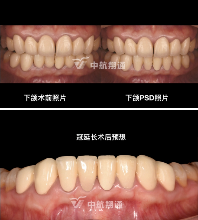 前牙全瓷美學(xué)修復(fù)臨床病例分享
