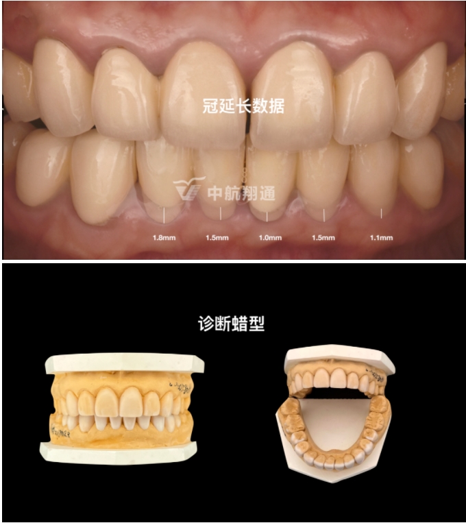 前牙全瓷美學(xué)修復(fù)臨床病例分享