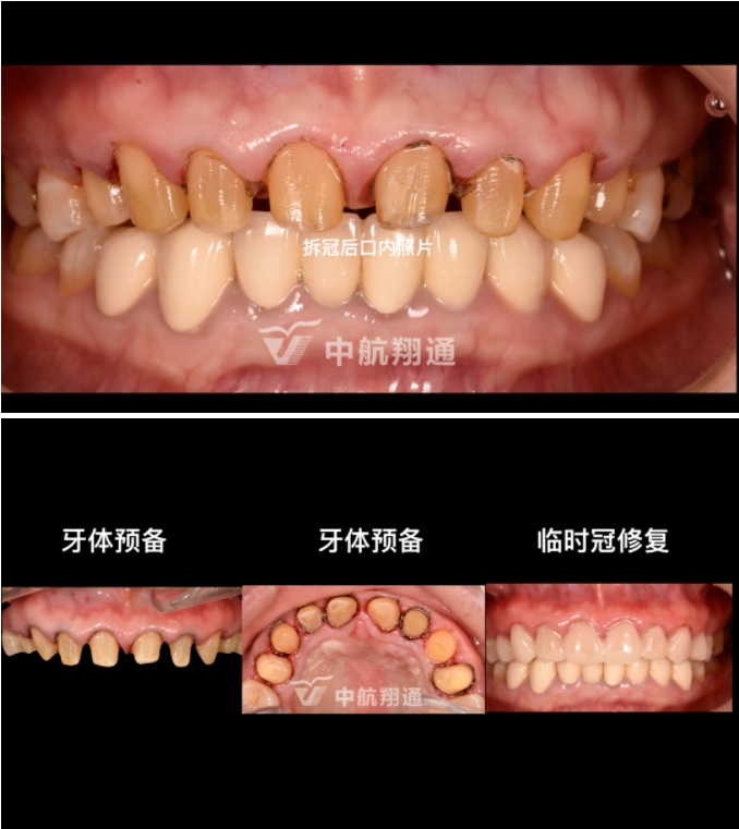 前牙全瓷美學(xué)修復(fù)臨床病例分享