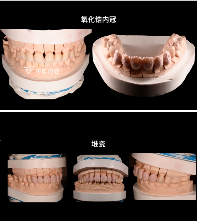 前牙全瓷美學(xué)修復(fù)臨床病例分享