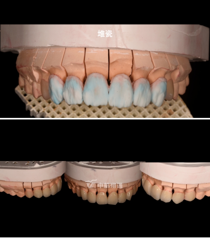 前牙全瓷美學(xué)修復(fù)臨床病例分享