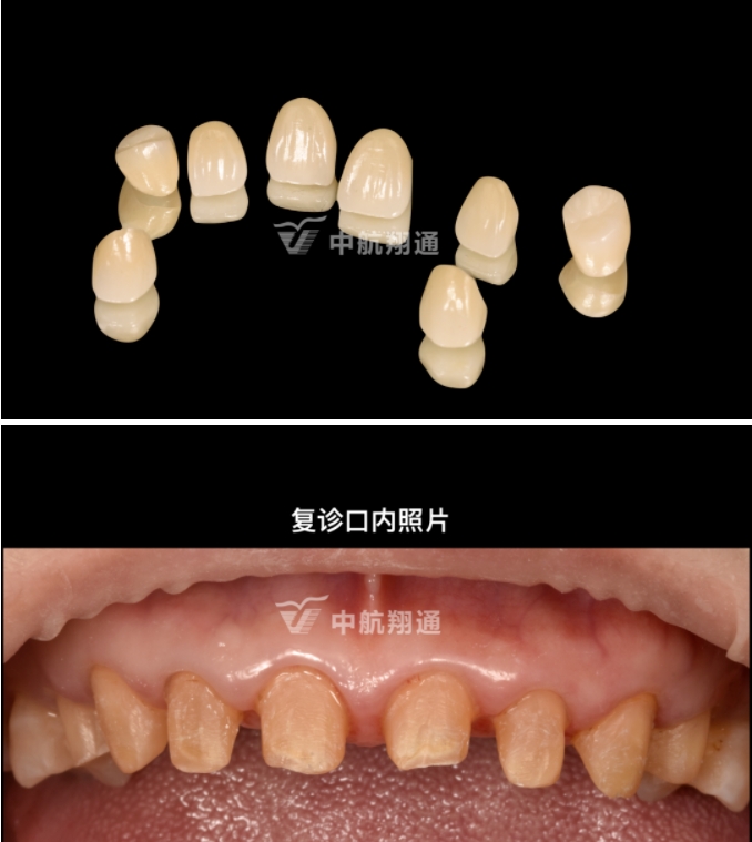 前牙全瓷美學(xué)修復(fù)臨床病例分享