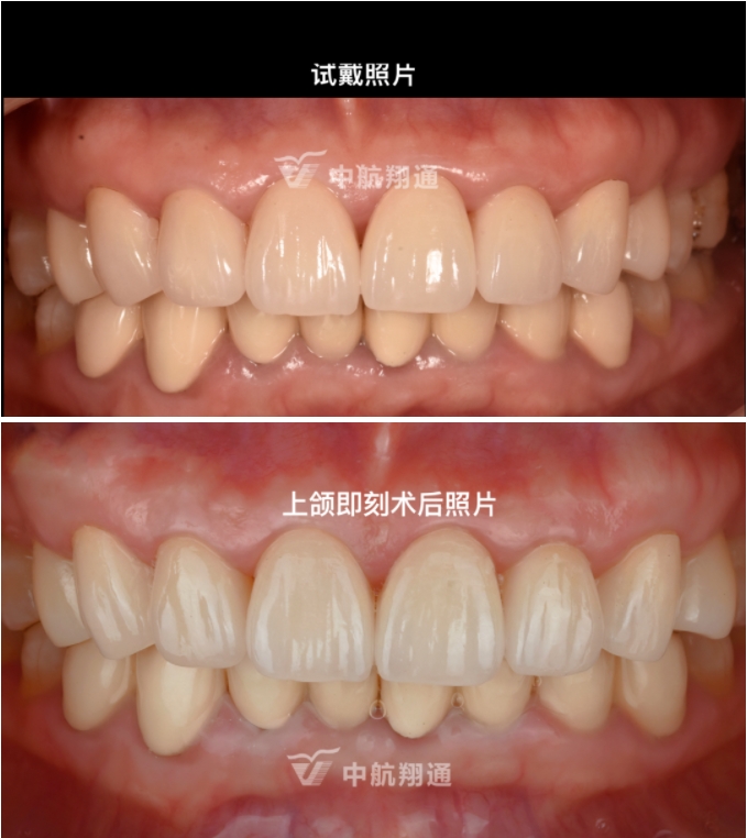 前牙全瓷美學(xué)修復(fù)臨床病例分享