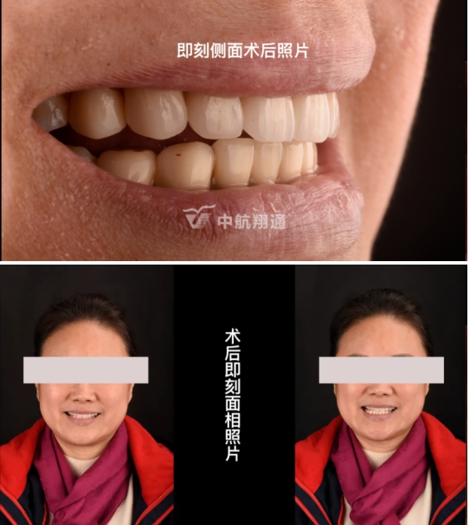 前牙全瓷美學(xué)修復(fù)臨床病例分享