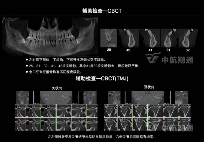 2024華人美學(xué)臨床病例大賽獲獎病例|以美學(xué)設(shè)計為導(dǎo)向的牙列重度磨耗患者全牙列咬合重建