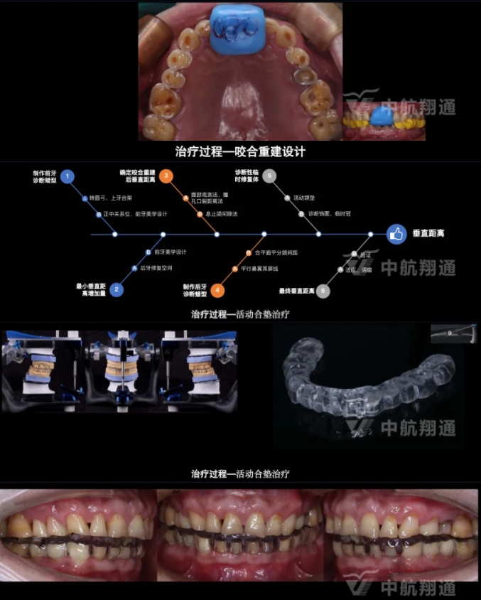 2024華人美學(xué)臨床病例大賽獲獎病例|以美學(xué)設(shè)計為導(dǎo)向的牙列重度磨耗患者全牙列咬合重建