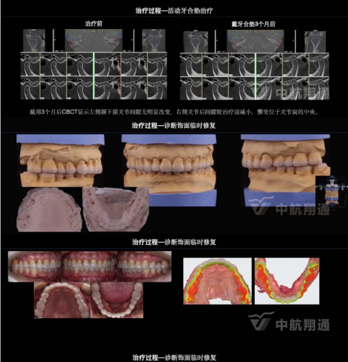 2024華人美學(xué)臨床病例大賽獲獎病例|以美學(xué)設(shè)計為導(dǎo)向的牙列重度磨耗患者全牙列咬合重建