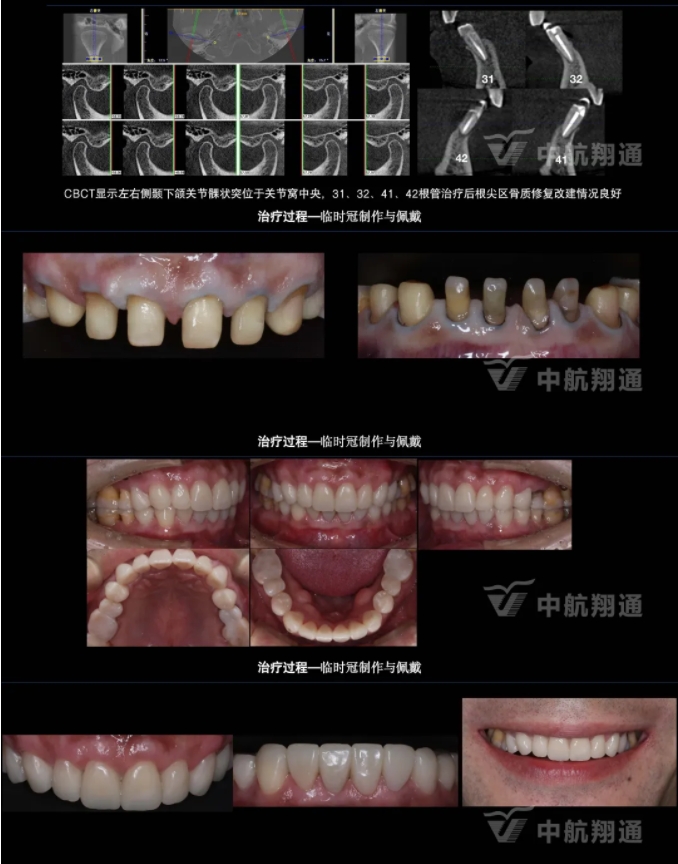 2024華人美學(xué)臨床病例大賽獲獎病例|以美學(xué)設(shè)計為導(dǎo)向的牙列重度磨耗患者全牙列咬合重建