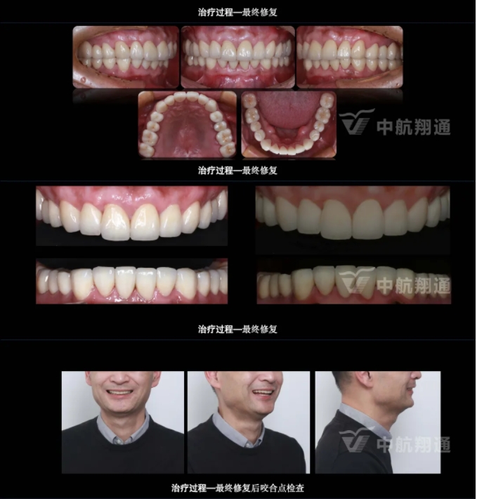 2024華人美學(xué)臨床病例大賽獲獎病例|以美學(xué)設(shè)計為導(dǎo)向的牙列重度磨耗患者全牙列咬合重建