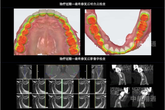 2024華人美學(xué)臨床病例大賽獲獎病例|以美學(xué)設(shè)計為導(dǎo)向的牙列重度磨耗患者全牙列咬合重建