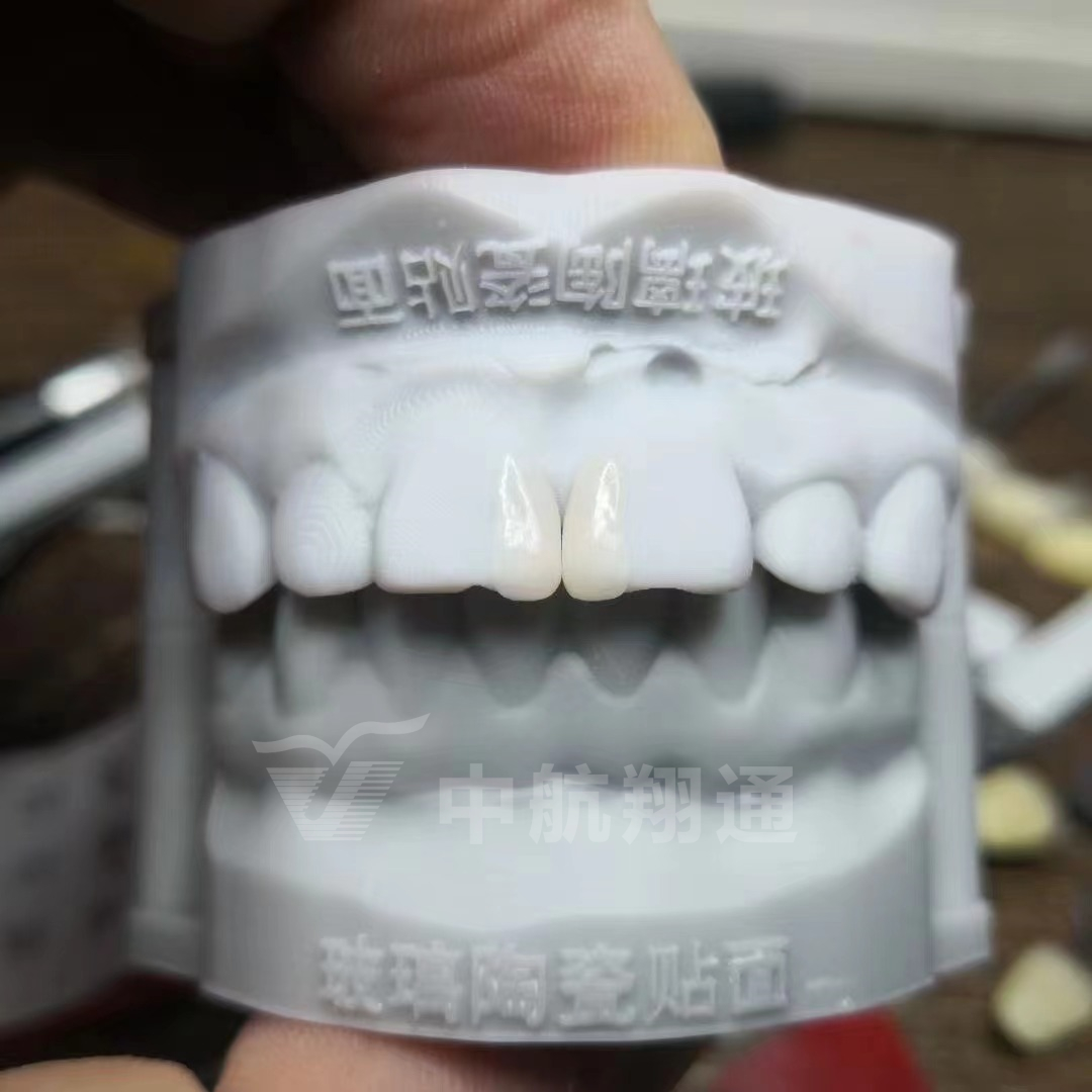 玻璃陶瓷前牙美學修復一例