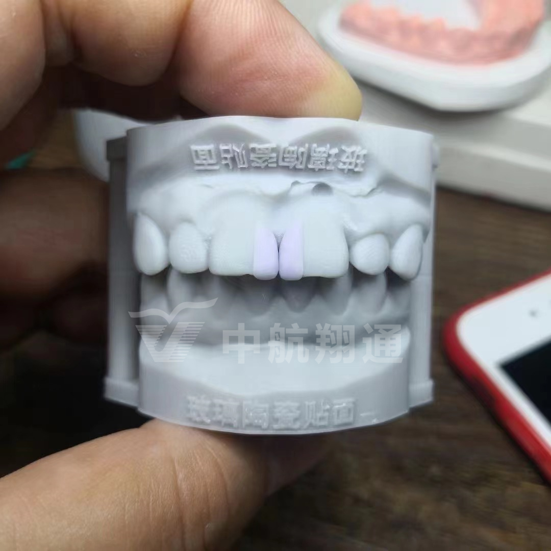 玻璃陶瓷前牙美學修復一例